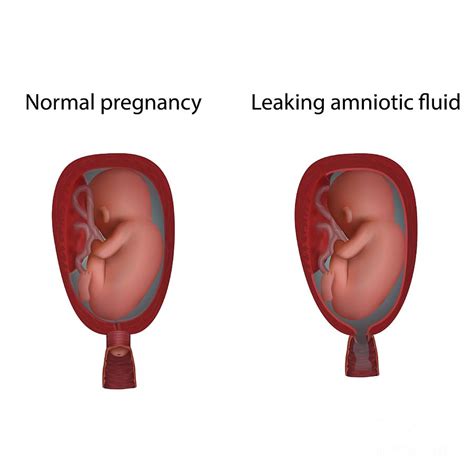 can amniotic fluid leak and then stop|Leaking Amniotic Fluid: How to Tell